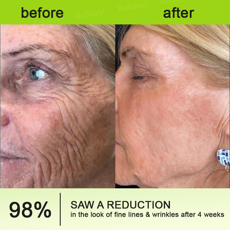 💎✅Made and shipped from the UK 💫Rolimey® Botox & Vita-A Retinol Shot Wrinkle-Lift Tightening cream - Last Day Promotion 70% OFF